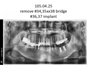 ImplantT0089001李映儀-案例分享